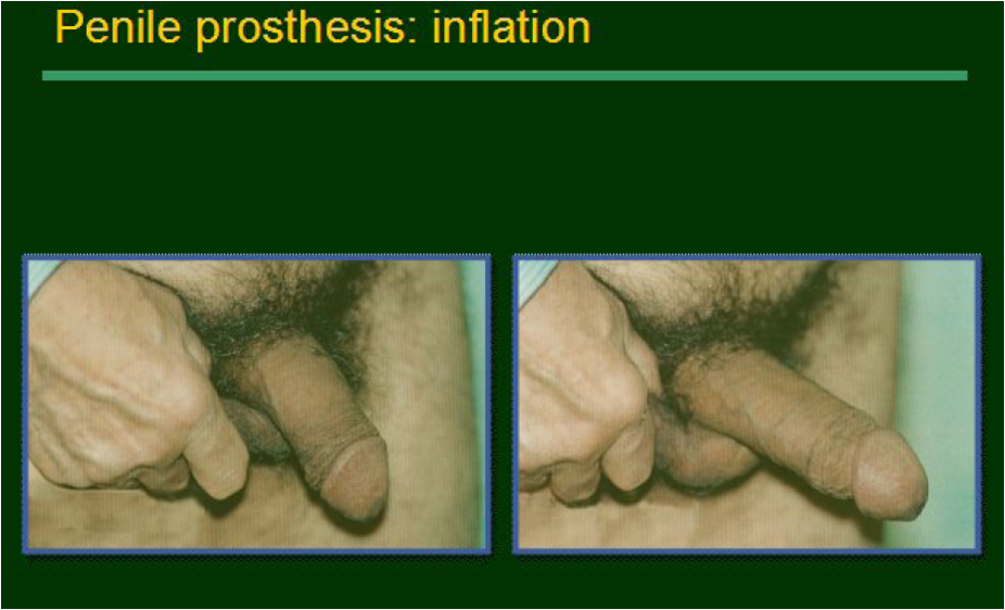 Pump for penis enlargement what effect